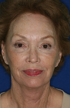 facelift1-after