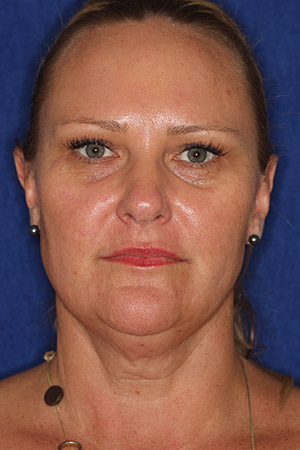 facelift1-before