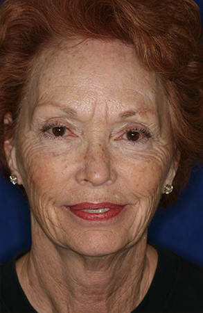 facelift1-before