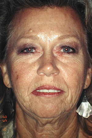 facelift4-before