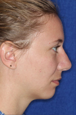 before-after-rhinoplasty-after