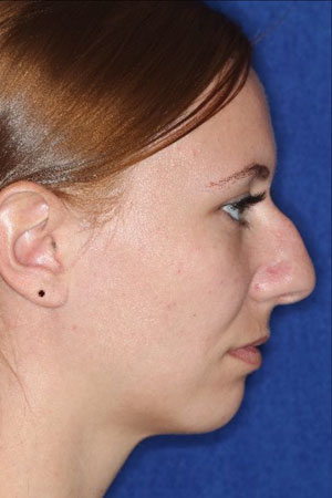 before-after-rhinoplasty-before